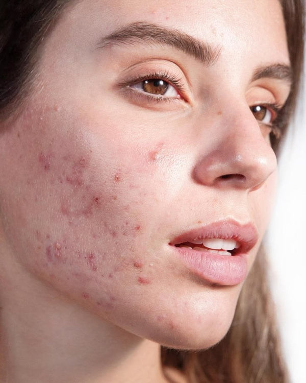 Acne-Prone Skin
