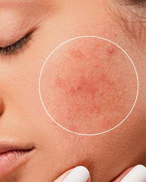 Sensitive Skin