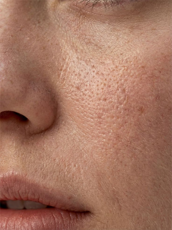 Oil & Pores